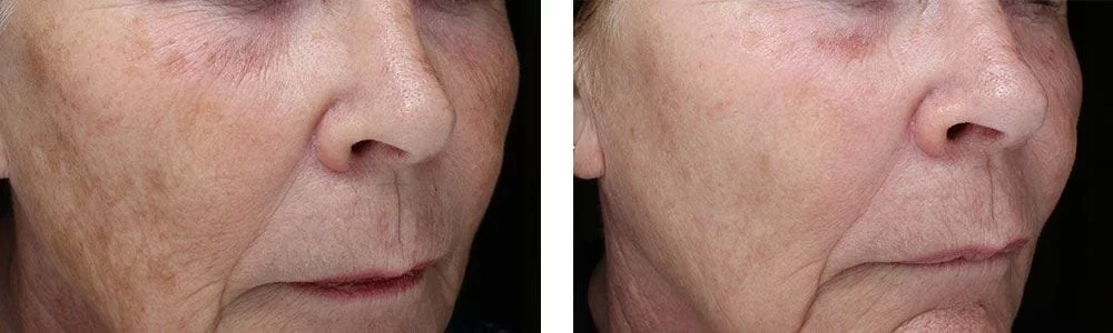 tratamiento de acné en Mallorca