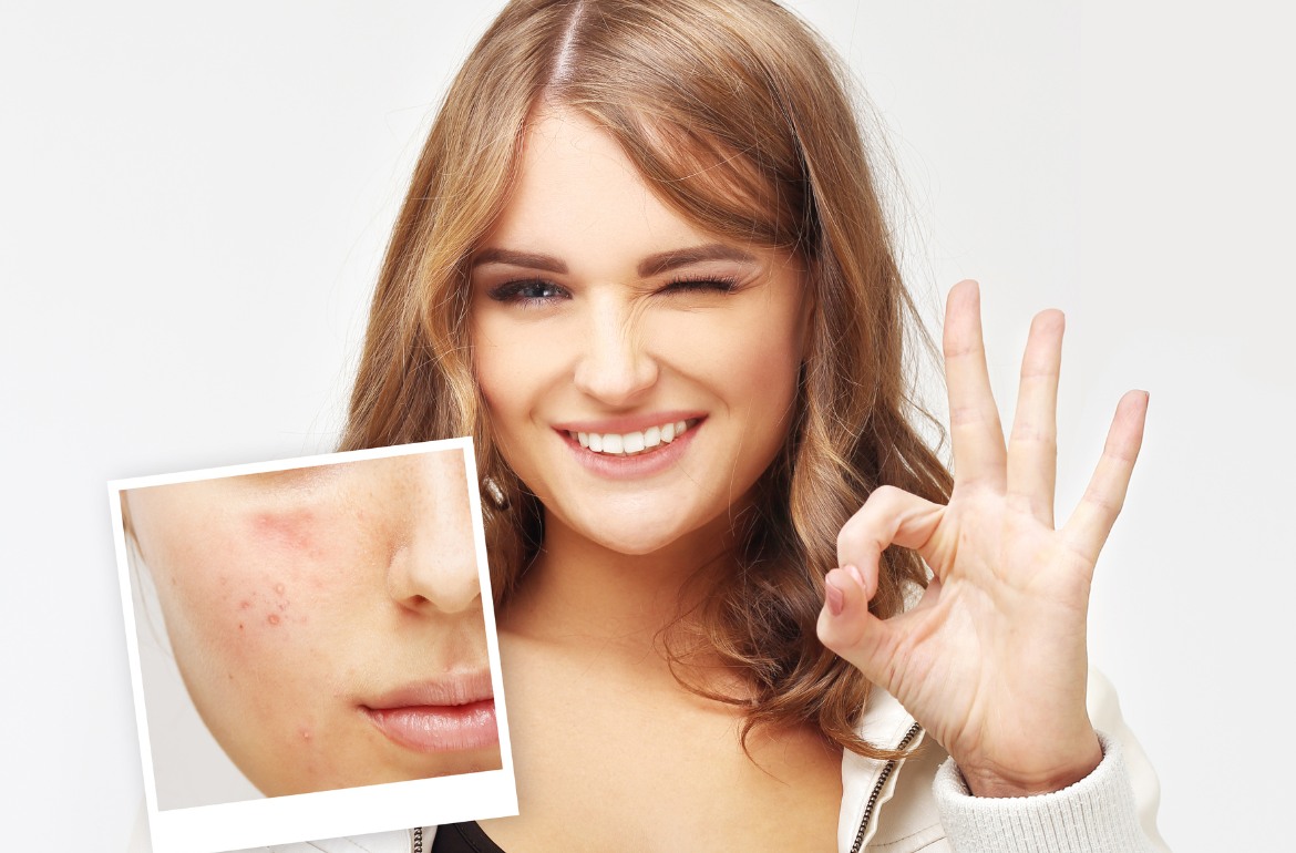 Eliminar acne con laser en Palma de Malloca y Manacor