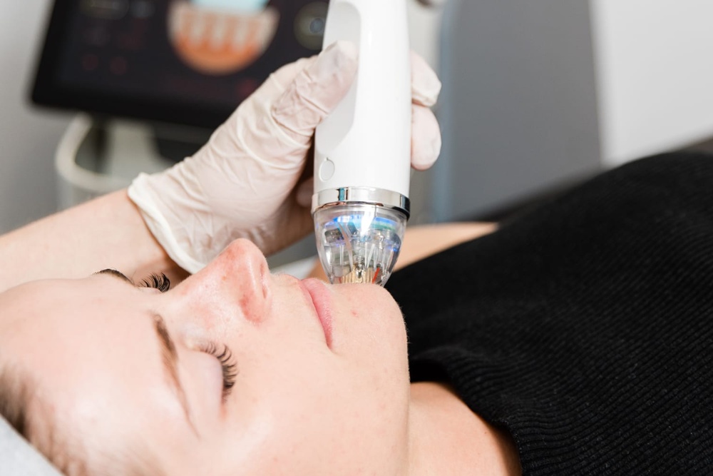 Terapia de radiofrecuencia con microagujas